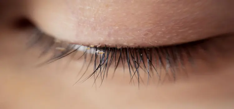 Get Rid of Eyelash Mites Naturally