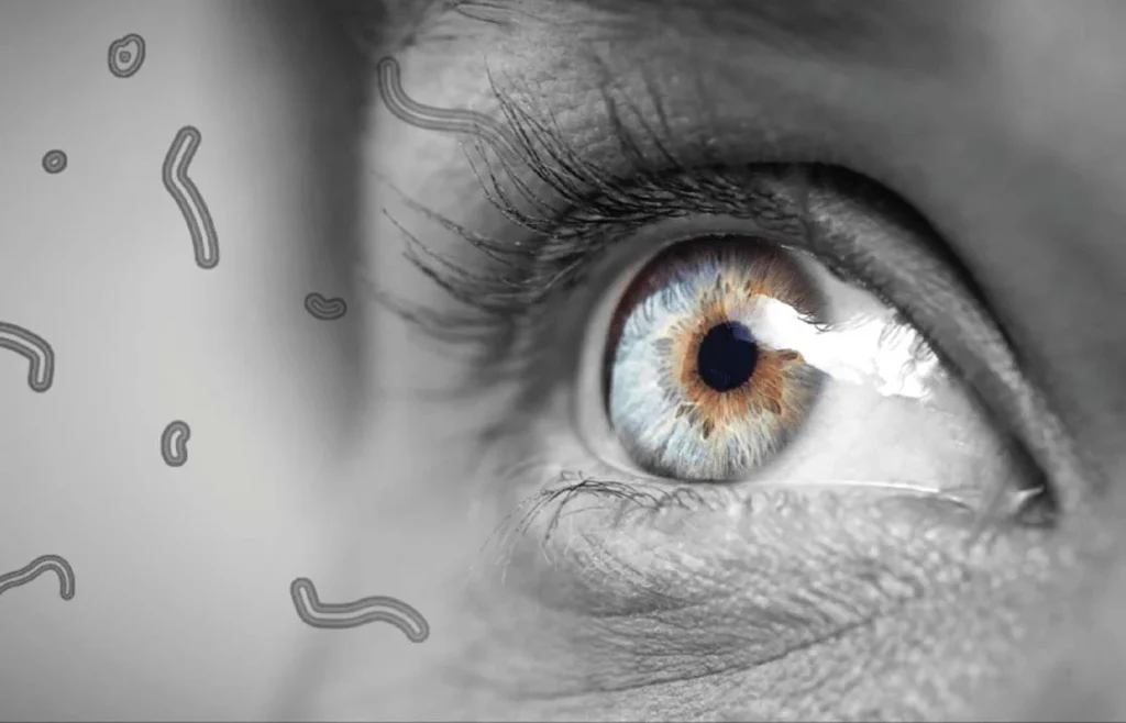 Eye Floaters